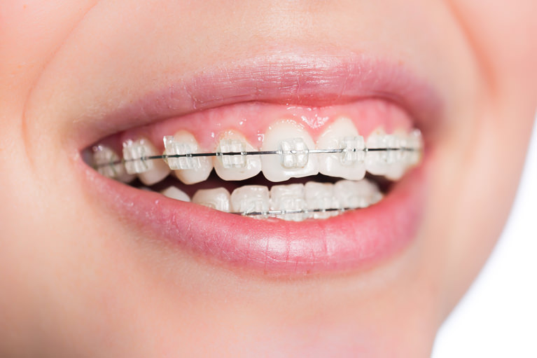 負担の少ない小児矯正