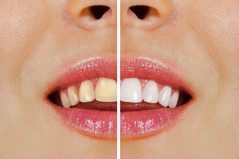 ウォーキングブリーチ